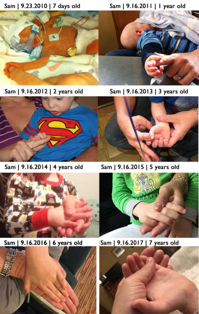 Sam the Anti-Preemie Hands